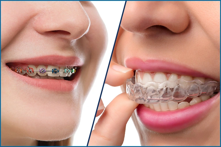 side-by-side comparison of traditional metal braces and clear orthodontic aligner, Invisalign.
