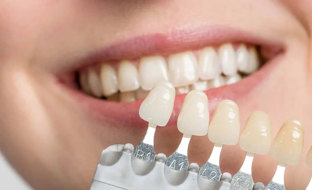 close-up of a person's smile with dental veneers being applied to the front teeth