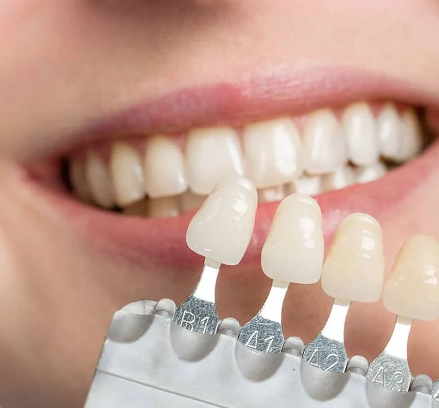 close-up of a person's smile with dental veneers being applied to the front teeth