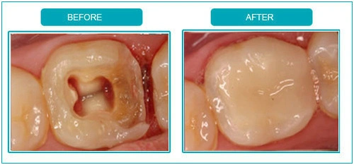 close-up comparison of a tooth before and after root canal treatment and filling