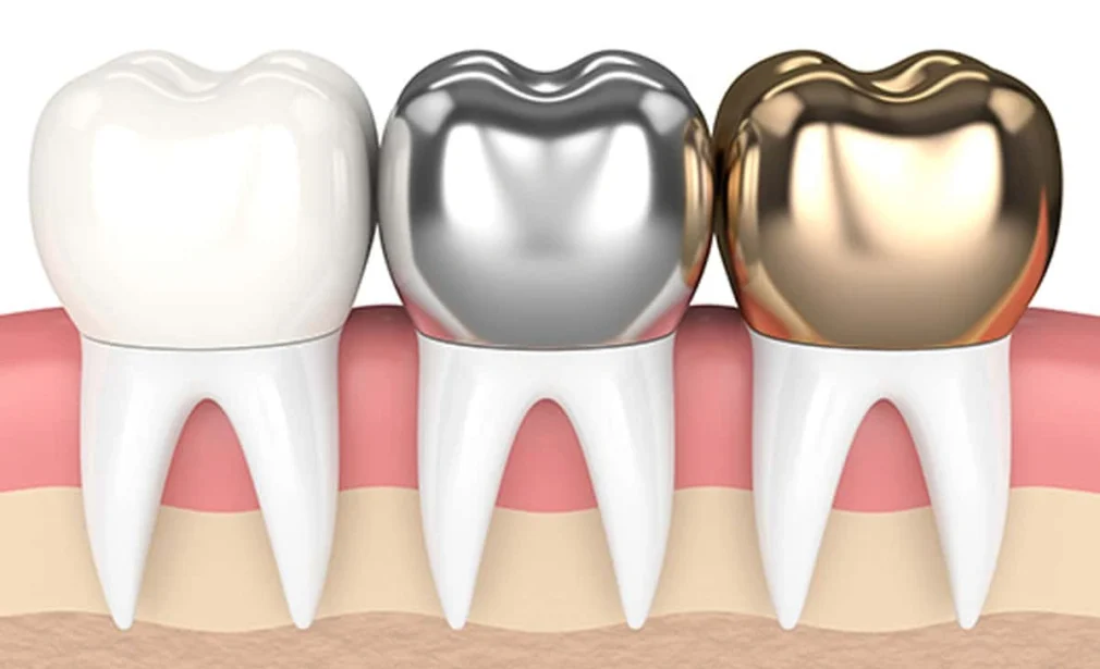 three different types of dental crowns over teeth - porcelain, porcelain fused metal and gold