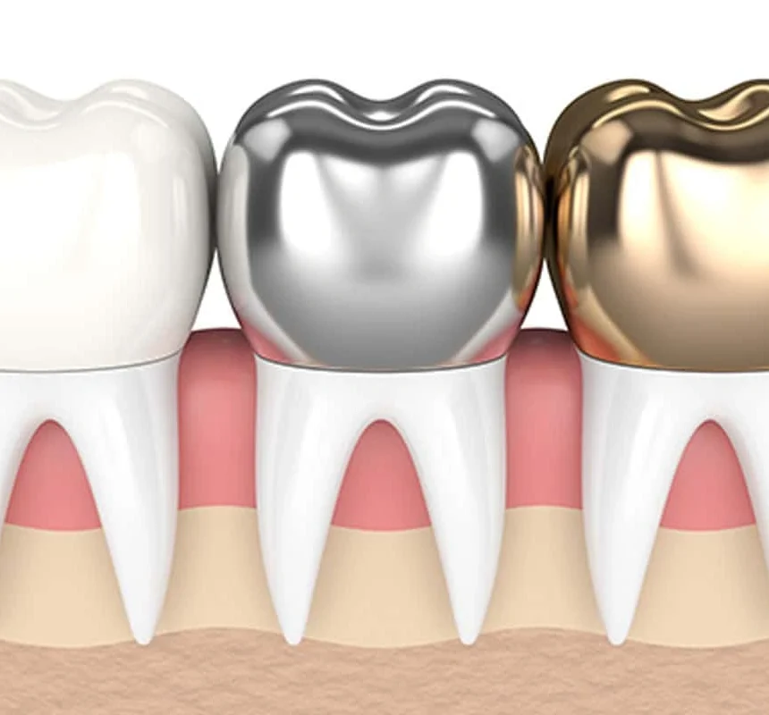 three different types of dental crowns over teeth - porcelain, porcelain fused metal and gold