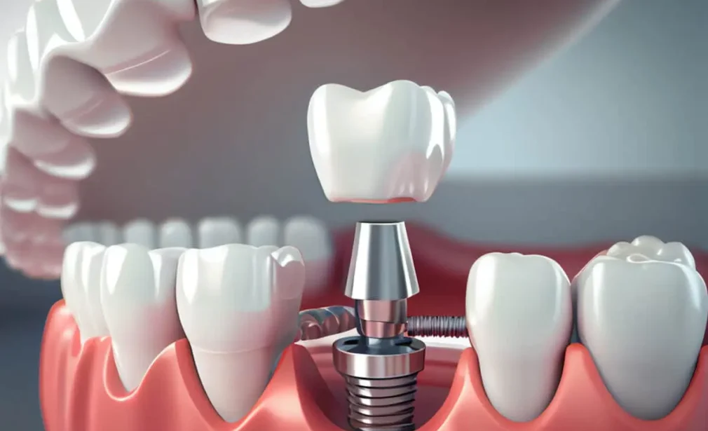 dental implant parts in the mouth, screw, abutment and crown