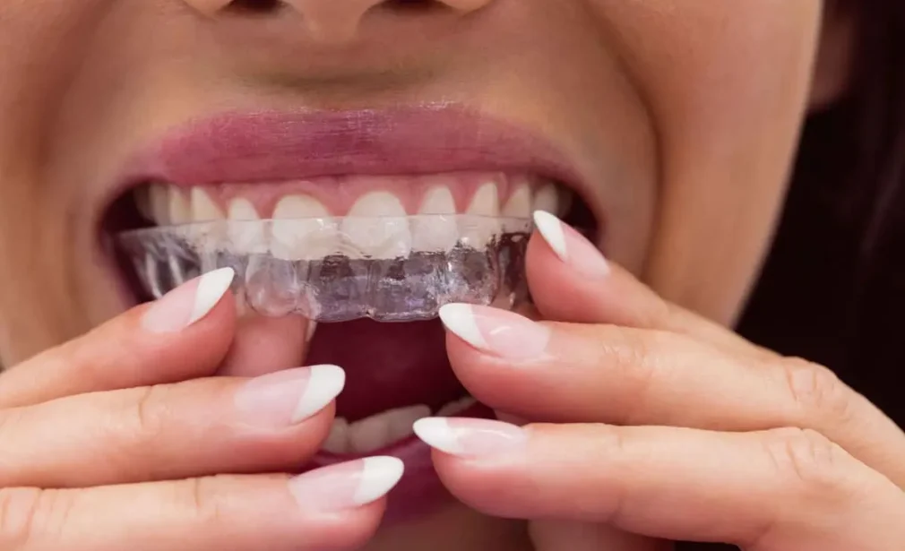clear aligners for the upper jaw, Invisalign