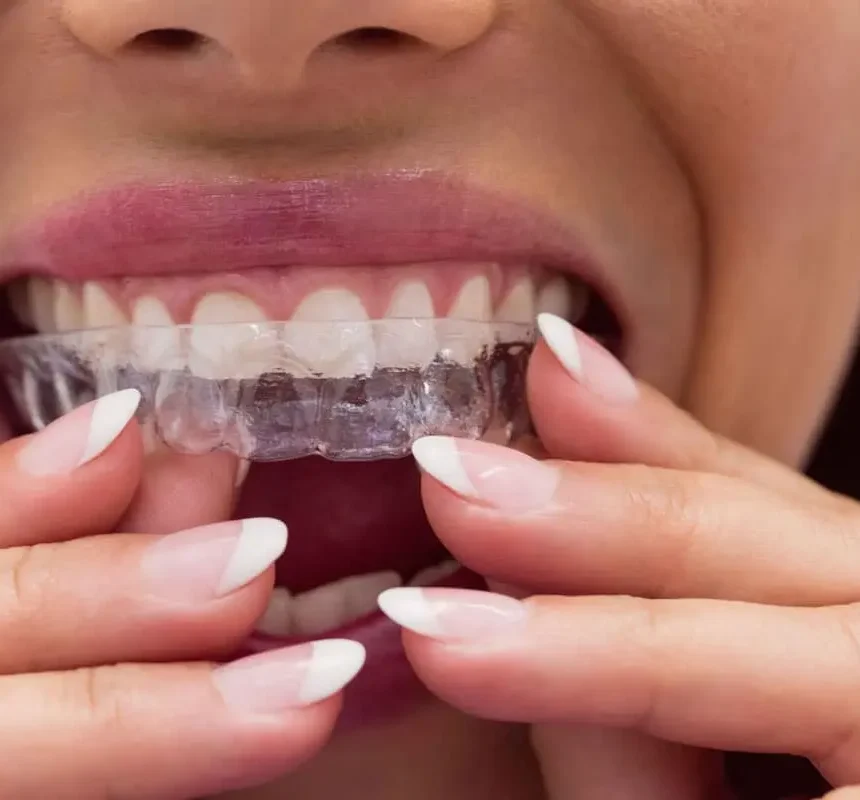 clear aligners for the upper jaw, Invisalign