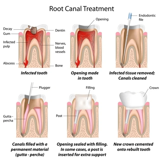 step-by-step explanation of a root canal treatment. Removing infected tissue, cleaning the canals, and then filling them with a permanent material, lastly a new crown is cemented onto the tooth.