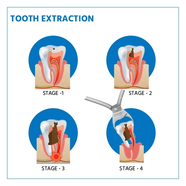 the four stages of a tooth extraction procedure. Small cavity, bigger cavity, then an even bigger cavity and inflamed roots. Finally the removal of the tooth.