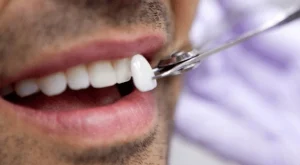 veneers in dubai